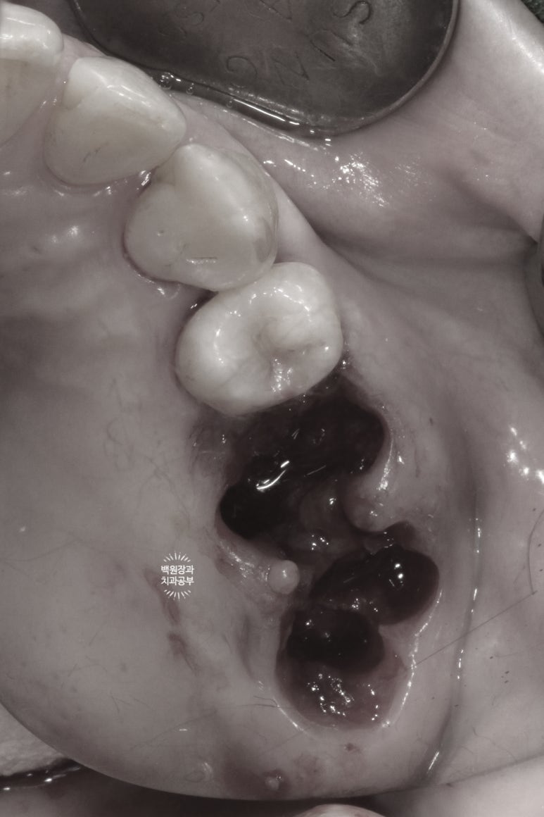 어금니 이빨 흔들림 잇몸이 부었을 때, 치주염에 걸린 치아를 뽑고 뼈이식을 해야할까요? 관련 이미지 6