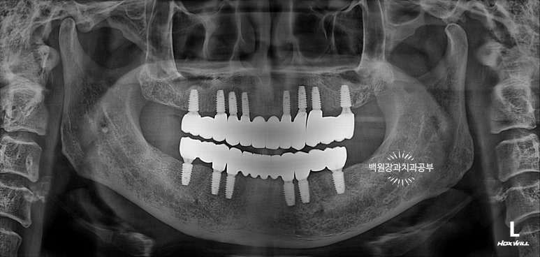 오스템임플란트 네비게이션 전체 임플란트 치료일기. 치료과정/치료기간/비용/솔직후기. 관련 이미지 38