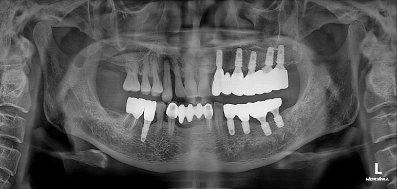 치주염 앞니 잇몸 염증으로 흔들릴 때 - 앞니 브릿지와 임플란트 장단점, 비용. 치료과정과 결과를 눈으로 보여주는 치과. 관련 이미지 5