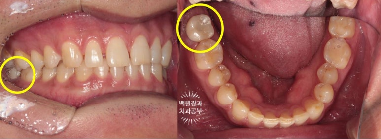 아래 어금니가 없어 위 어금니가 내려왔어요. 부분 교정을 곁들인 스트라우만 임플란트 수술. 억울한 신경치료를 피해보자. 치료과정/치료기간/비용/후기. 관련 이미지 16