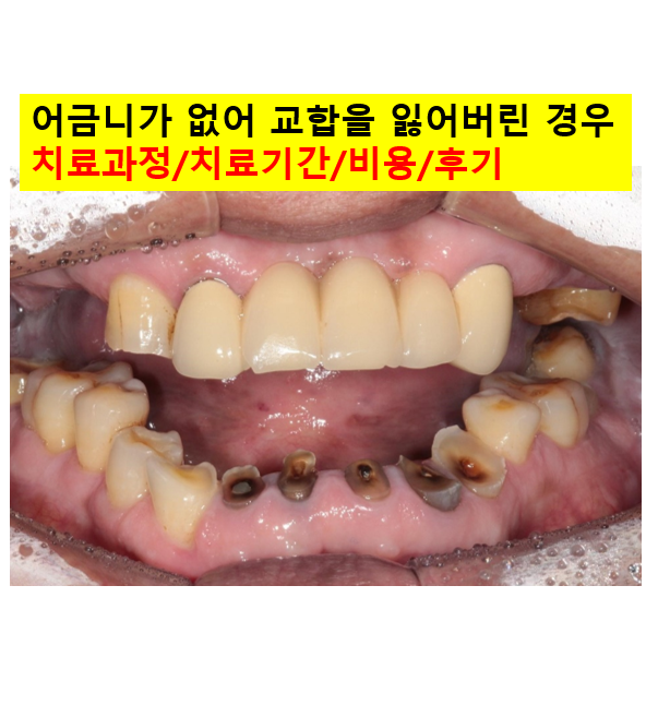 뿌리만 남은 앞니, 어금니가 없어 교합이 무너진 증례. 흡연자의 전체 오스템BA임플란트 재건증례. 치료과정/치료기간/비용/후기. 관련 이미지 1