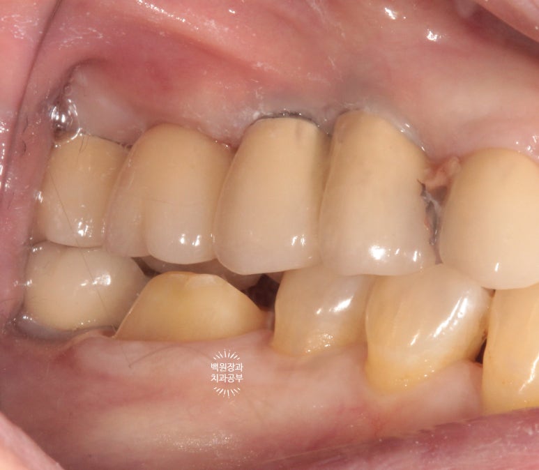 어금니 보철물이 떨어졌어요. 골드인레이 탈락 후 지르코니아 크라운으로 치료. 충치치료과정/치료기간/비용/후기. 관련 이미지 11