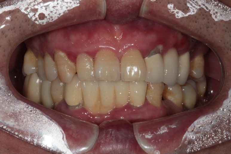 치주염 앞니 잇몸 염증으로 흔들릴 때 - 앞니 브릿지와 임플란트 장단점, 비용. 치료과정과 결과를 눈으로 보여주는 치과. 관련 이미지 2