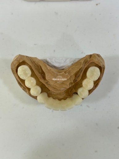 오스템임플란트 네비게이션 전체 임플란트 치료일기. 치료과정/치료기간/비용/솔직후기. 관련 이미지 22