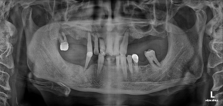 큰 어금니를 잃을 정도의 풍치를 앓으셨다면, 조속한 어금니 임플란트는 필수입니다. 관련 이미지 2