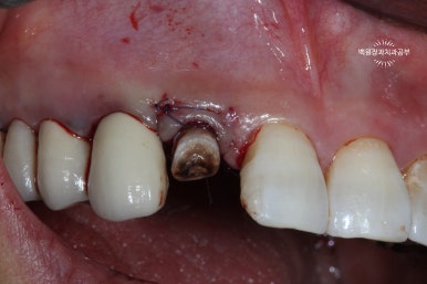 외과적 정출술 (surgical extrusion) - 치아를 살리는 마지막 방법. 치료과정/치료기간/비용/사진. 관련 이미지 6