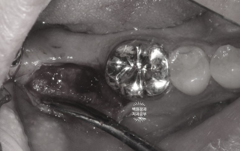 신경치료한 치아 부러짐! 뼈이식 하면서 임플란트 수술하는 과정/기간/비용. 관련 이미지 5