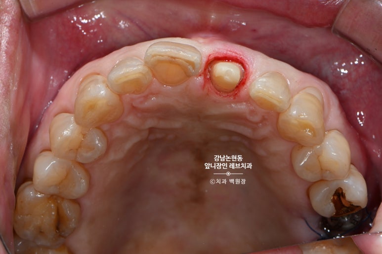 강남논현동치과 60대 치아부러짐 - 신경치료하고 기둥심고 앞니 크라운 잘하는곳! 가격/과정/후기/부작용. 관련 이미지 12