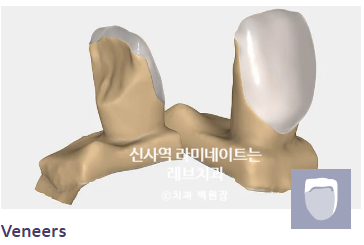 신사역 라미네이트, 잘하는 치과의 치료과정과 재료.설명.비용.후기. 관련 이미지 5