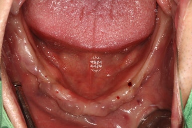 만성치주염으로 인해 아주 좁아진 잇몸뼈에 광범위한 뼈이식 + 전체임플란트. 신사 레브치과. 관련 이미지 37