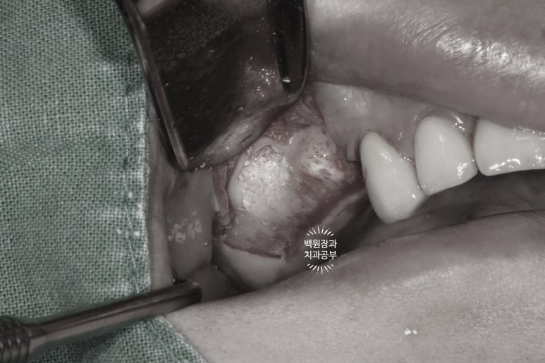 부분틀니 대신 어금니 임플란트를 만들어드립니다. 40대 어금니 상악동 뼈이식 임플란트. 치료기간/비용/과정. 관련 이미지 10