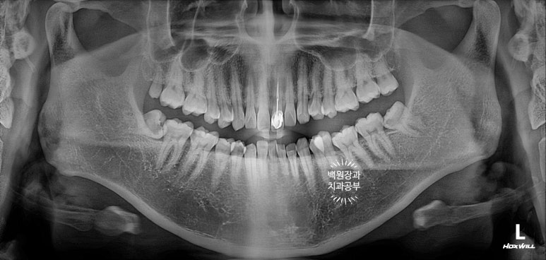 앞니 머리가 기둥째 부러졌어요. 발치 동시 뼈이식 오스템 BA 임플란트. 치료과정/치료기간/비용/후기. 압구정 치과. 관련 이미지 3