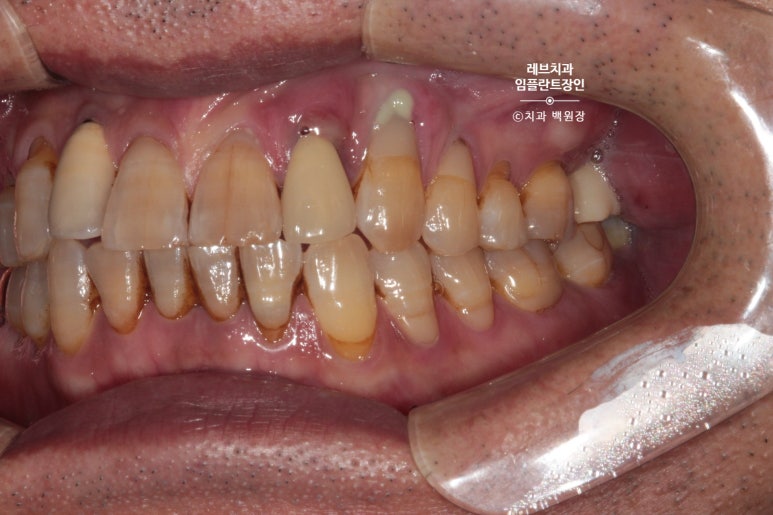 앞니 부러짐? 뽑고 바로 임플란트 + 뼈이식. 앞니 흔들림? 뽑고 1달 기다리고 임플란트 + 뼈이식. 신사역 치과 후기/비용/과정. 관련 이미지 15