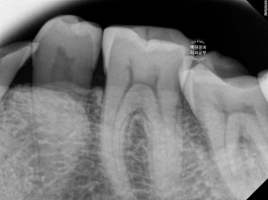 뿌리만 남은 앞니, 어금니가 없어 교합이 무너진 증례. 흡연자의 전체 오스템BA임플란트 재건증례. 치료과정/치료기간/비용/후기. 관련 이미지 9