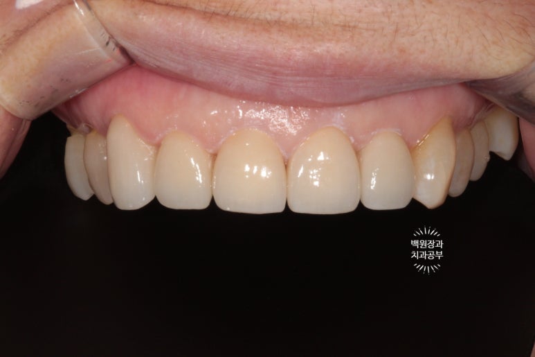 삐뚤빼뚤 앞니 세로 금  - 신경치료 없이 지르코니아 크라운으로. 상악동뼈이식술 임플란트. 관련 이미지 13