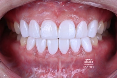 레브네이트 베이직. 치아미백과 치아교정을 한번에! 치아삭제 사진 있음. 신사역 치과 앞니라미네이트 모델/비용/후기. 관련 이미지 21