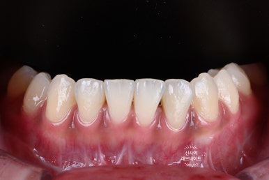 What About Laminates at Sinsa Station? Rev Dental Clinic’s Revnate. image 9