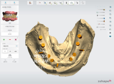 임플란트장인의 마음으로 8개월간 전체임플란트 완성. 치주과 전문의. 관련 이미지 10