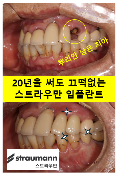 스트라우만 임플란트로 이뽑고 바로심는치과 - 믿고 사용하는 세계 1위 스위스 임플란트 회사. 관련 이미지 1