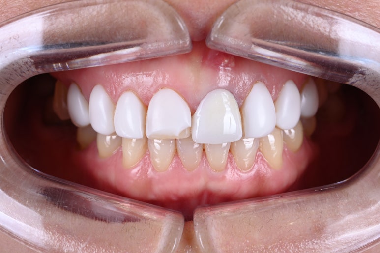 레브네이트 엑스퍼트 - 앞니 무삭제 라미네이트. 40대 벌어진 앞니에 변색된 레진은 이제 그만! 압구정 치과 추천 전후/비용. 관련 이미지 2