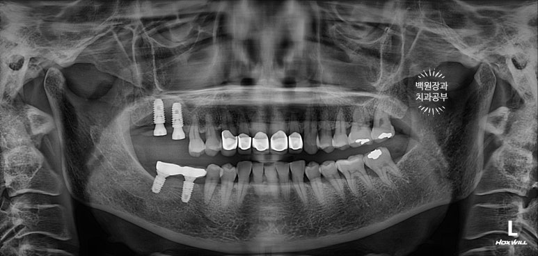 삐뚤빼뚤 앞니 세로 금  - 신경치료 없이 지르코니아 크라운으로. 상악동뼈이식술 임플란트. 관련 이미지 17