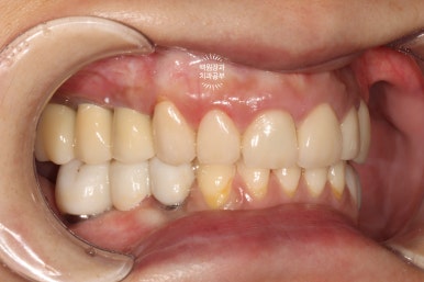 부분틀니 대신 어금니 임플란트를 만들어드립니다. 40대 어금니 상악동 뼈이식 임플란트. 치료기간/비용/과정. 관련 이미지 23