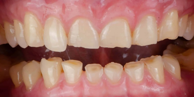 이갈이보톡스를 치과에서 치료받아야 하는 이유. 코어톡스 가격 주기 부작용 정보. 관련 이미지 3