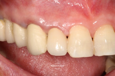 외과적 정출술 (surgical extrusion) - 치아를 살리는 마지막 방법. 치료과정/치료기간/비용/사진. 관련 이미지 14