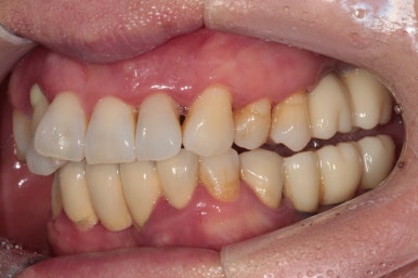 앞니가 풍치로 흔들거려요. 심한 치주염인데 임플란트 가능할까요? 치료과정/치료기간/비용/성공후기. 신금호역 치과 추천. 관련 이미지 4