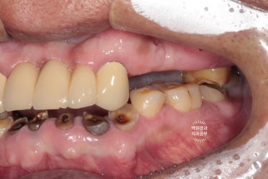 뿌리만 남은 앞니, 어금니가 없어 교합이 무너진 증례. 흡연자의 전체 오스템BA임플란트 재건증례. 치료과정/치료기간/비용/후기. 관련 이미지 3