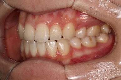 잇몸 성형과 치아미백 그리고 지르코니아 20대 앞니 크라운 치료. 치료과정/기간/비용. 관련 이미지 14