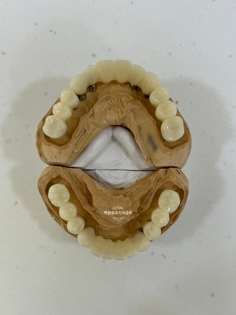 오스템임플란트 네비게이션 전체 임플란트 치료일기. 치료과정/치료기간/비용/솔직후기. 관련 이미지 20