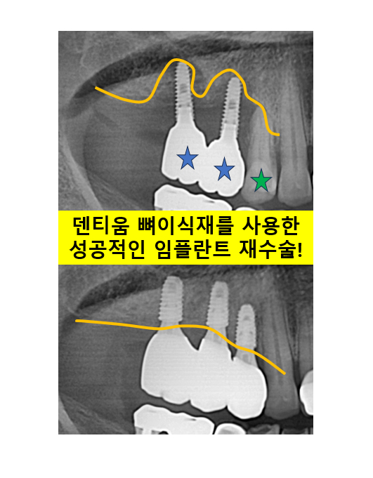 60대 임플란트 주변에서 고름이 나와요. 실패한 임플란트 제거 후 재수술. 덴티움 뼈이식재를 사용한 치조골 이식술. 관련 이미지 1