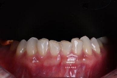 아래앞니 라미네이트도 무삭제로 가능한가요? 레브네이트 베이직 가격/비용/후기/추천. 관련 이미지 3