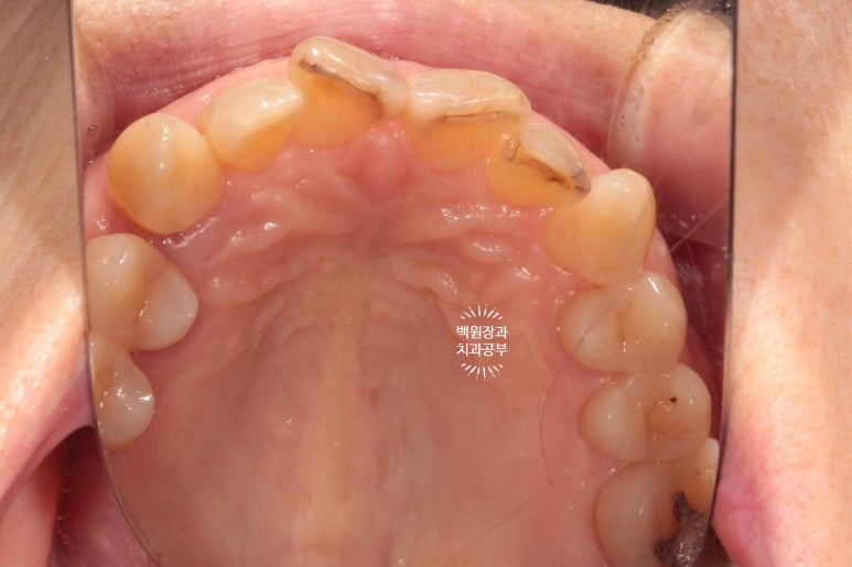삐뚤빼뚤 앞니 세로 금  - 신경치료 없이 지르코니아 크라운으로. 상악동뼈이식술 임플란트. 관련 이미지 5