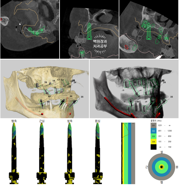 불편한 틀니를 아직도 쓰시나요? 전체 임플란트 치료비용/치료기간/치료과정. 관련 이미지 9