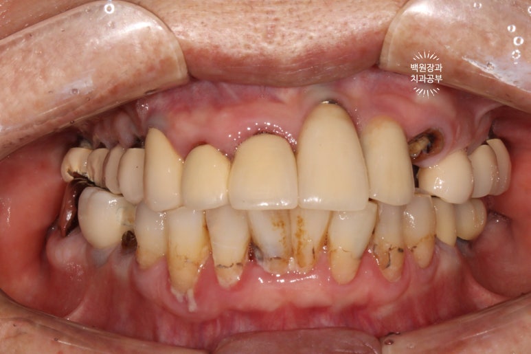 스트라우만 임플란트로 이뽑고 바로심는치과 - 믿고 사용하는 세계 1위 스위스 임플란트 회사. 관련 이미지 4