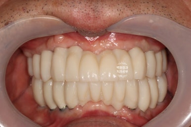 불편한 틀니를 아직도 쓰시나요? 전체 임플란트 치료비용/치료기간/치료과정. 관련 이미지 25