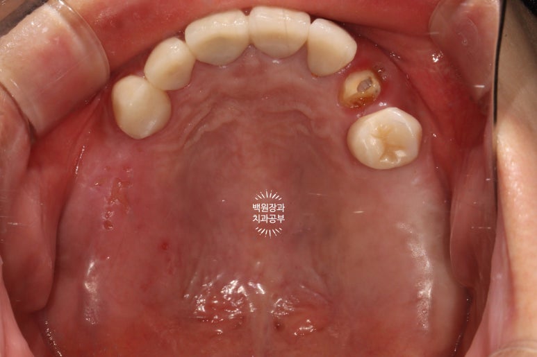 부분틀니 대신 어금니 임플란트를 만들어드립니다. 40대 어금니 상악동 뼈이식 임플란트. 치료기간/비용/과정. 관련 이미지 5