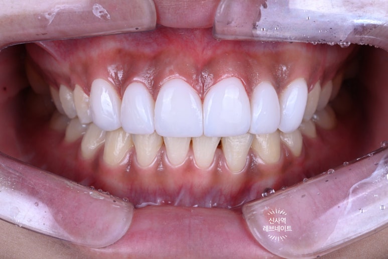 What About Laminates at Sinsa Station? Rev Dental Clinic’s Revnate. image 16