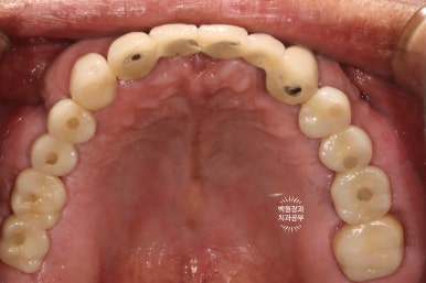 뿌리만 남은 앞니, 어금니가 없어 교합이 무너진 증례. 흡연자의 전체 오스템BA임플란트 재건증례. 치료과정/치료기간/비용/후기. 관련 이미지 28