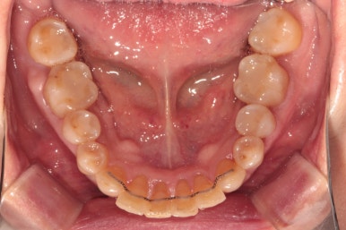 삐뚤어진 앞니를 8개월만에 가지런하게 만드는 50대 성인부분교정. 신사역 교정치과. 치료과정/기간/비용. 관련 이미지 22
