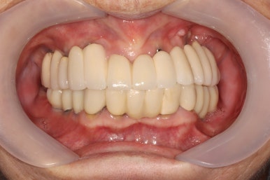 부분틀니를 오래써서 어금니가 아플 때, 아래턱 양쪽 어금니 임플란트 잘하는 강남임플란트치과 관련 이미지 36
