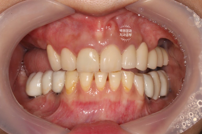 부분틀니 대신 어금니 임플란트를 만들어드립니다. 40대 어금니 상악동 뼈이식 임플란트. 치료기간/비용/과정. 관련 이미지 19