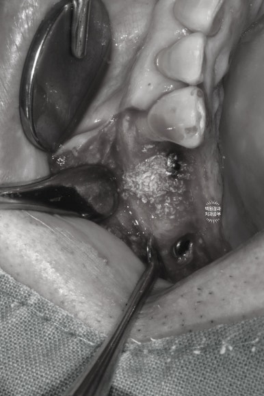 임플란트장인의 마음으로 8개월간 전체임플란트 완성. 치주과 전문의. 관련 이미지 12