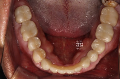뿌리만 남은 앞니, 어금니가 없어 교합이 무너진 증례. 흡연자의 전체 오스템BA임플란트 재건증례. 치료과정/치료기간/비용/후기. 관련 이미지 29