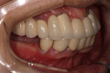 부분틀니를 오래써서 어금니가 아플 때, 아래턱 양쪽 어금니 임플란트 잘하는 강남임플란트치과 관련 이미지 4