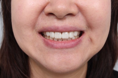 레브네이트 엑스퍼트 - 앞니 무삭제 라미네이트. 40대 벌어진 앞니에 변색된 레진은 이제 그만! 압구정 치과 추천 전후/비용. 관련 이미지 16