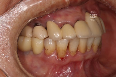 스트라우만 임플란트로 이뽑고 바로심는치과 - 믿고 사용하는 세계 1위 스위스 임플란트 회사. 관련 이미지 27