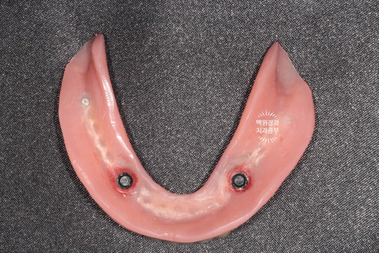임플란트틀니 - 오버덴쳐. 오스템BA임플란트 이용한 최고의 가성비 치료. 치료과정/치료기간/비용/후기. 관련 이미지 15